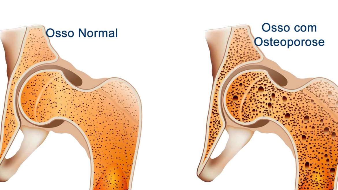 Osteoporose e Atividade Física