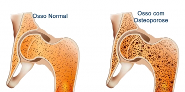 Osteoporose e Atividade Física