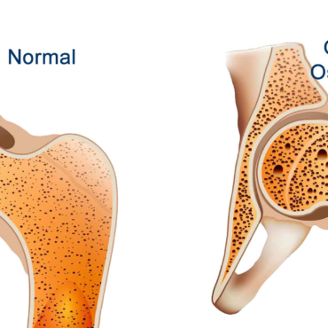 Osteoporose e Atividade Física